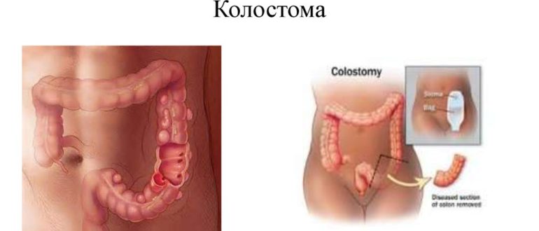 Диарея из толстого кишечника при введении колостомы