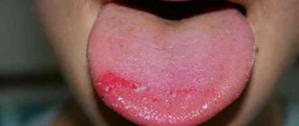 На языке пятна появляются и исчезают