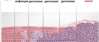 Дисплазия 1 степени, впч