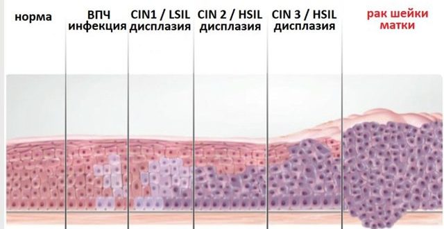 Дисплазия 1 степени, впч