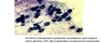 Микроскопия мазка носового секрета