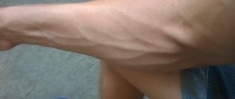 Вены посинели видимо и выпирают