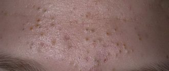 Чёрная точка на прыще