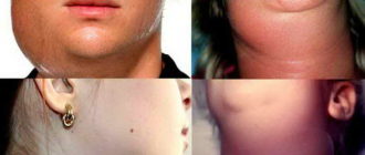 Воспаление подчелюстной слюнной железы