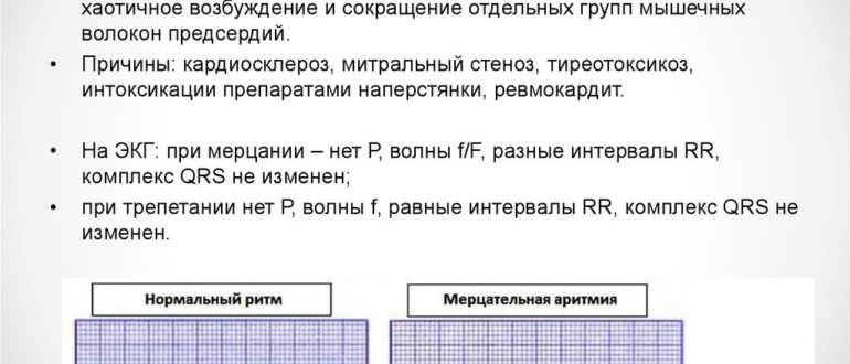 Мерцательная аритмия