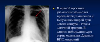 Выбухание по левому контуру 2 дуги аорты на рентгенограмме