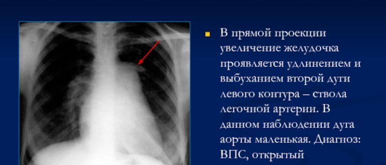 Выбухание по левому контуру 2 дуги аорты на рентгенограмме