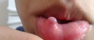 Вавка на внутренней стороне верхней губы
