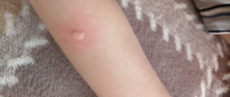 Волдыри у ребёнка