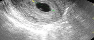 Внематочная беременность или маленький срок беременности?