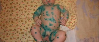 Ветряная оспа на половых губах