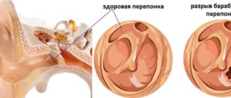 Экссудативный отит. Поможет ли аденотомия?