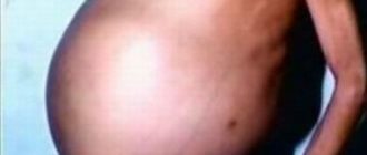 Надувается живот и мешает дышать