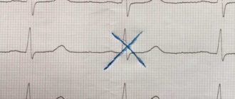 Выраженная Синусовая аритмия, вегето сосудистая дистония