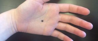Черные точки на ладони