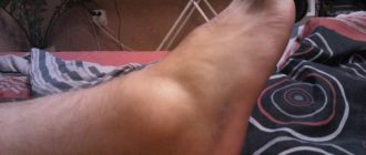 Частое подворачивание стопы, припухлость сустава