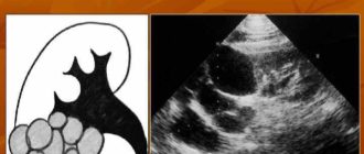 Мультилокулярная киста почки