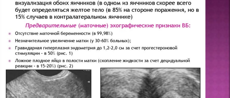 УЗИ для исключения внематочной беременности