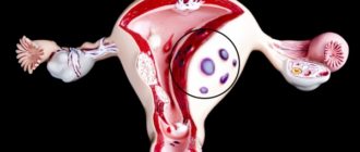 Эндометриоз длительная мазня после месячных