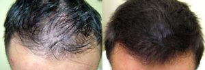 Выпадение волос при приеме Циклодинона