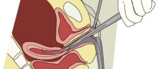 Диагностическое выскабливание