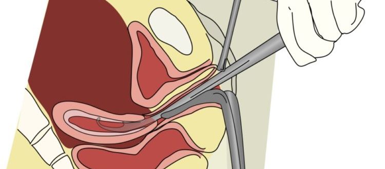 Диагностическое выскабливание
