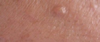 На головке пятна или прыщи не пойму