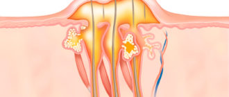 Восполение абсцесс после фурункула. Уплотнение