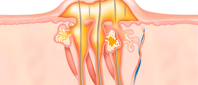 Восполение абсцесс после фурункула. Уплотнение