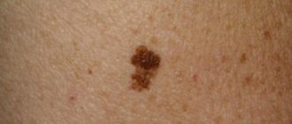 На половом члене пятна похожие на родинки