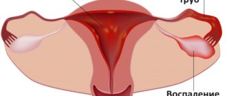Воспаление по женски