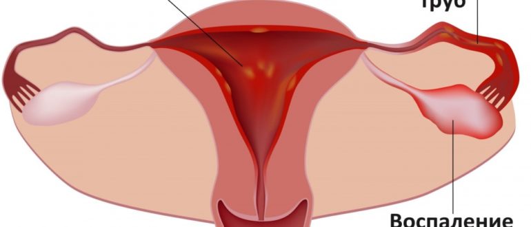 Воспаление по женски