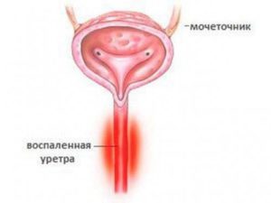 Воспаление губ уретры