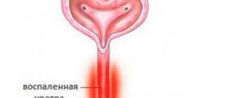 Воспаление губ уретры