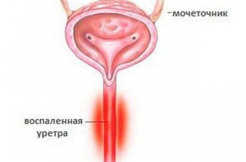 Воспаление губ уретры