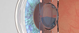 Выбор ИОЛ на второй глаз