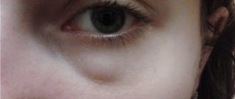 Красная большая шишка на лице под глазом