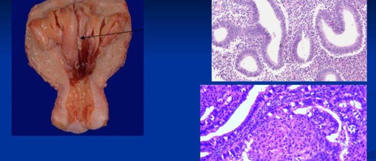Внутренний эндометриоз и железистая гиперплазия эндометрия