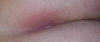 Выпуклость и потемнение вокруг ануса