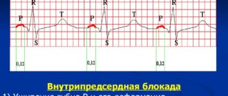 Что такое предсердная блокада 1 ст