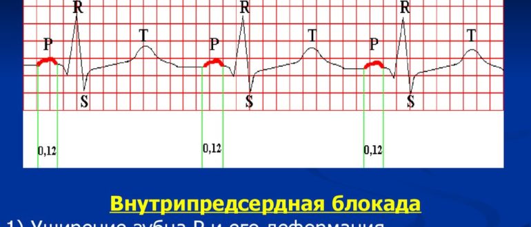 Внутрипредсердная проводимость. Внутрипредсердная блокада 1 степени. Внутрипредсердная блокада.