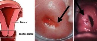 Может ли быть эритроплакия на слизистой вульвы