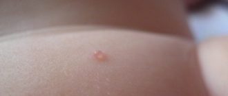 Водяные прыщики у ребенка