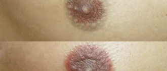 Выделения из железы монтгомери