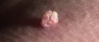 ВПЧ 16, 18 прижигание