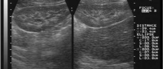 Дисметоболическая нефропатия. УЗИ почек