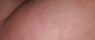 Волдырь на внутренней стороны бедра