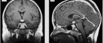 Микрокиста гипофиза
