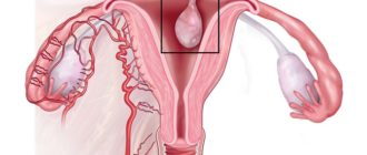 Что же мне удалили - полип или миому? Так бывает?