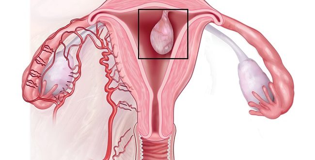 Что же мне удалили - полип или миому? Так бывает?